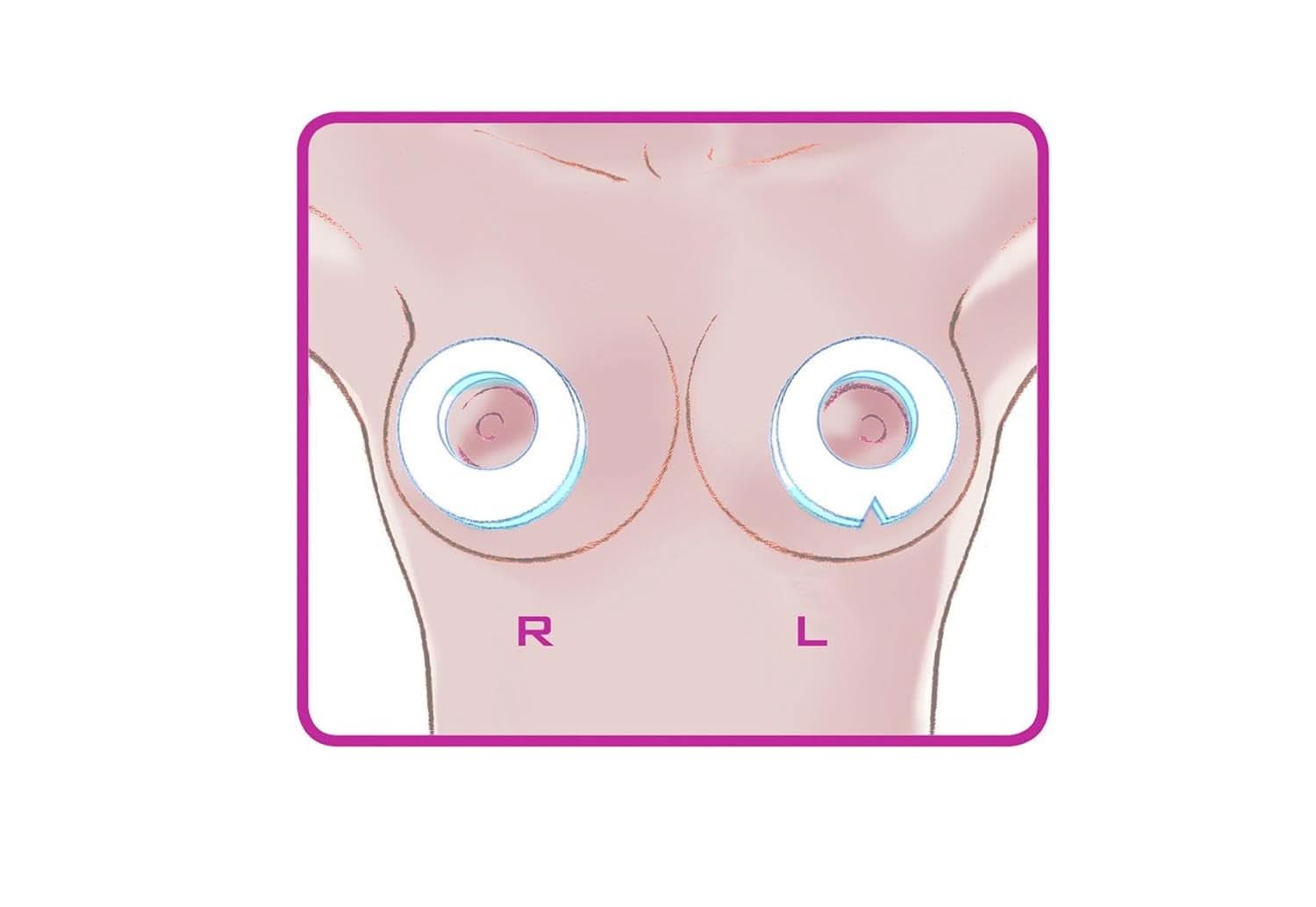 ELANEE Brust-Ringe, Schutz Der Brustwarze Bh-Kontakt Durch Hohllagerung, Ideal Bei Wunden, Entzündeten Brustwarzen Durch Stillen, 10 Stück (222-00) Accessoires Alimentation et allaitement Bebe Naty Shop