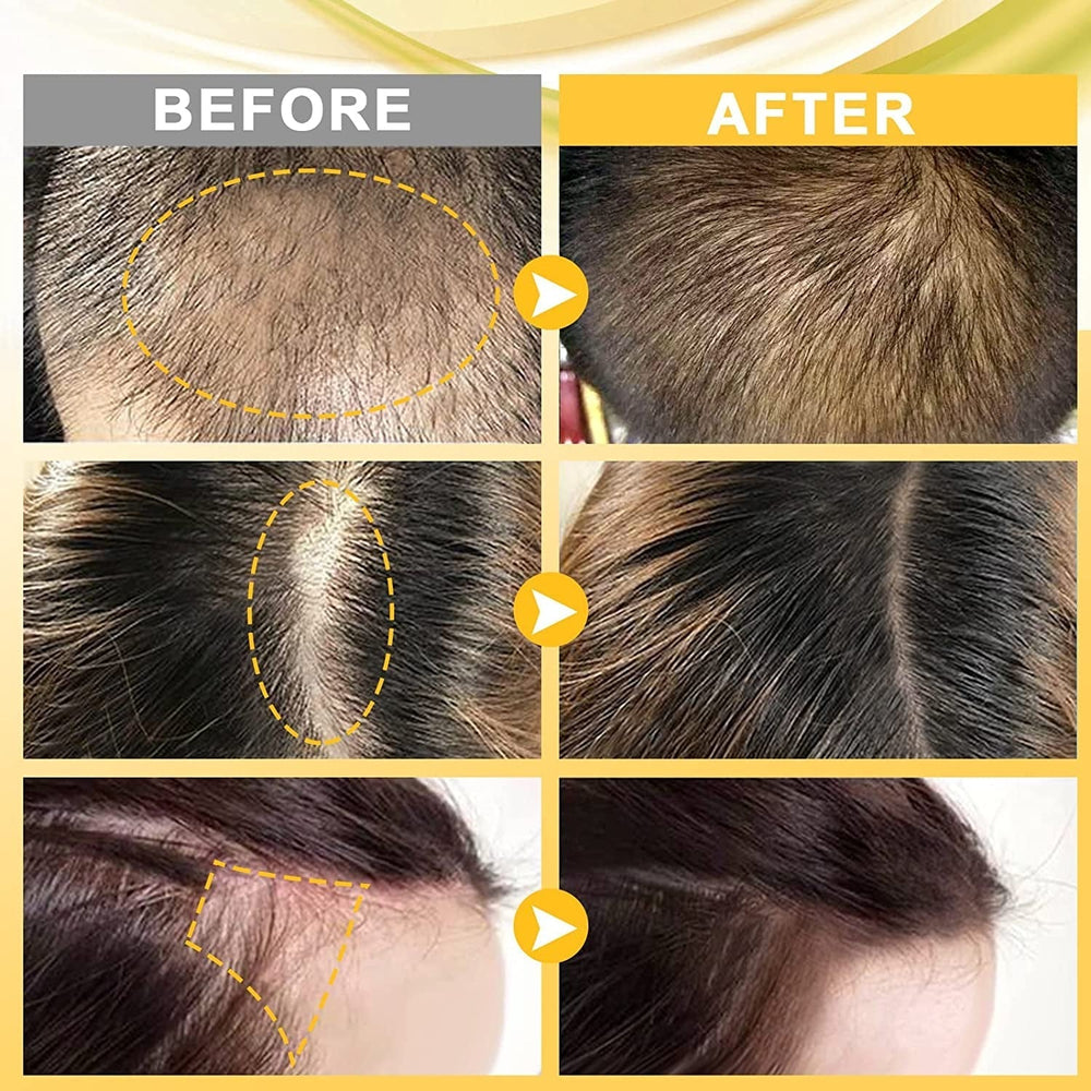 Dermaroller Set Rouleau cutané microneedling de 0,5 mm avec sérum pour la croissance des cheveux, anti-chute, 30 ml, perte de cheveux et traitement des cheveux Soins capillaires Naty Shop