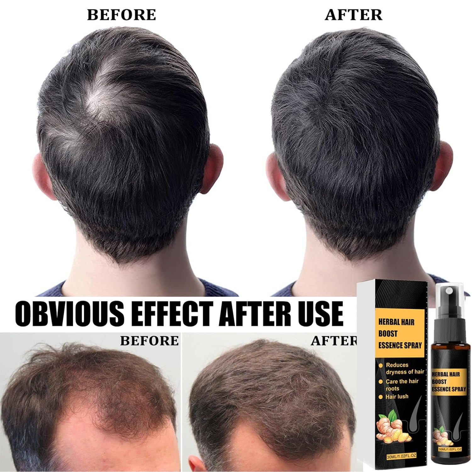 Kit de tratament avansat pentru creșterea părului 30ml 2PCS, spray pentru creșterea părului, set de role și esențe pentru creșterea părului, ser pentru creșterea părului, împotriva căderii părului, ser pentru creșterea avansată a părului Ingrijirea parului Naty Shop